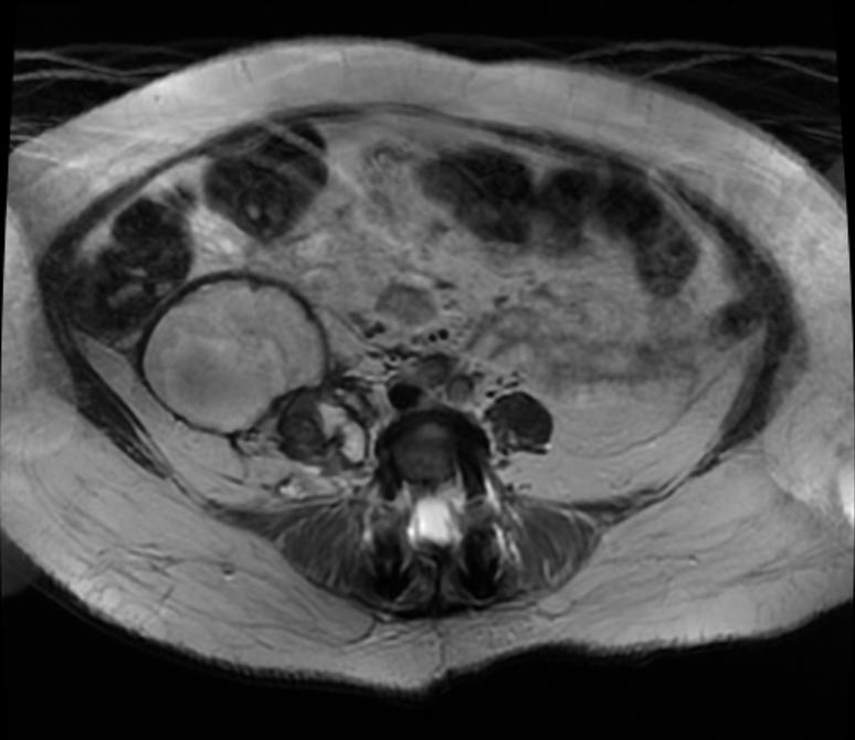 File:Retroperitoneal hematoma MRI 003.jpg