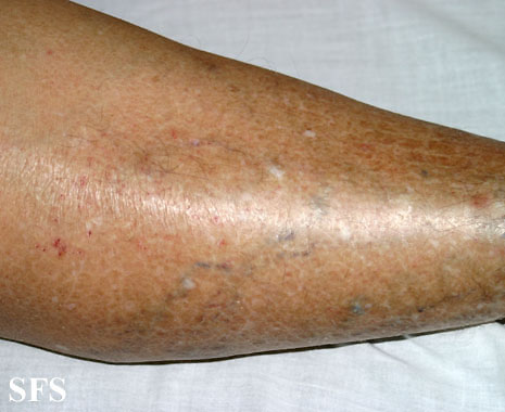 File:Xerotic eczema01.jpg