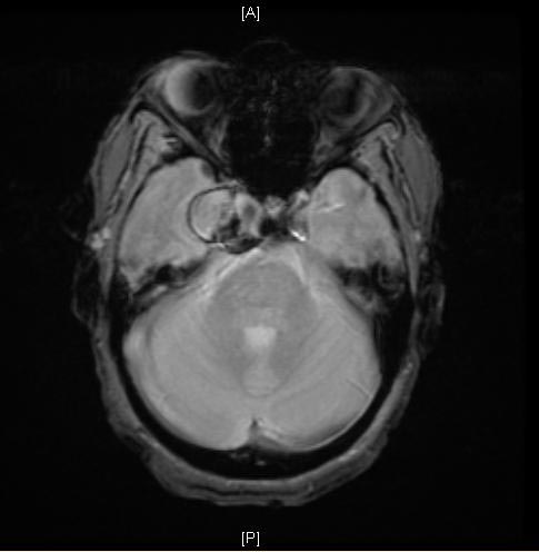 MRI: A large cavernous sinus aneurysm