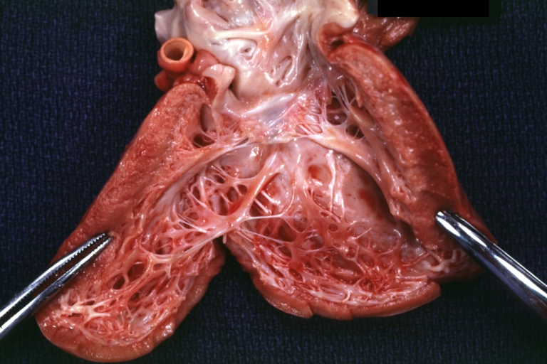 Endocardial fibroelastosis: Gross, an example of LV endocardial thickening associated with anomalous origin of left coronary artery from pulmonary artery
