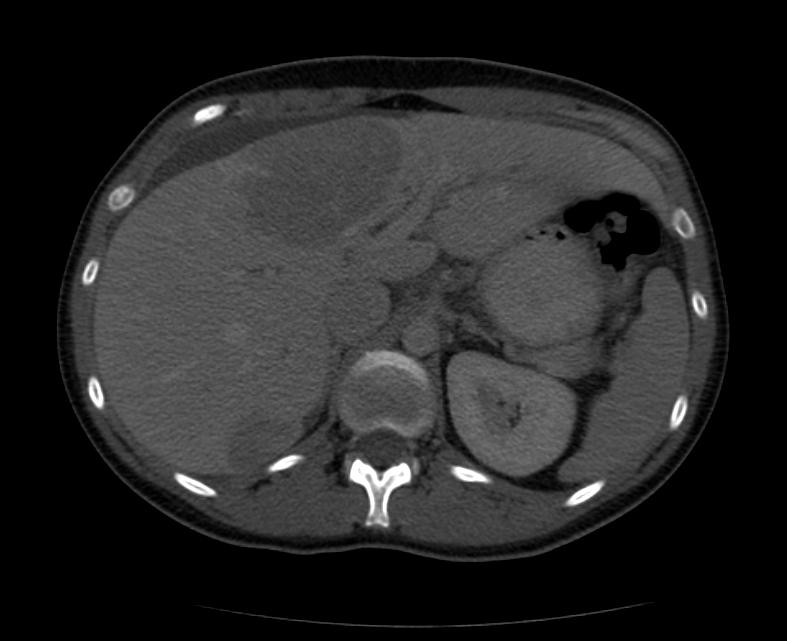 CT portal venous phase: A patient with multiple adenoma