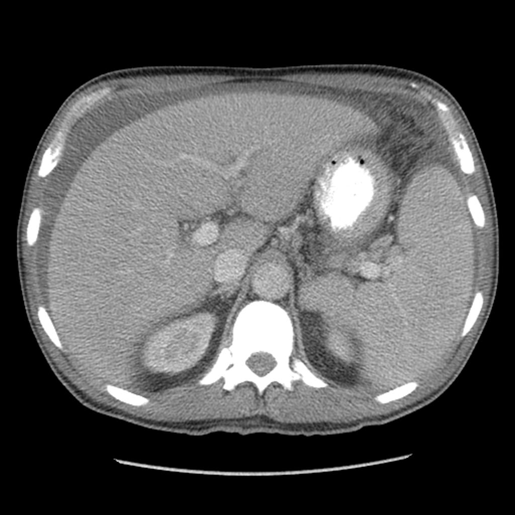 CT of the abdomen demonstrates ascites, hepatosplenomegaly, and upper abdominal lymphadenopathy. Windowing to bone confirms the diffuse sclerosis seen on the plain films.[2]