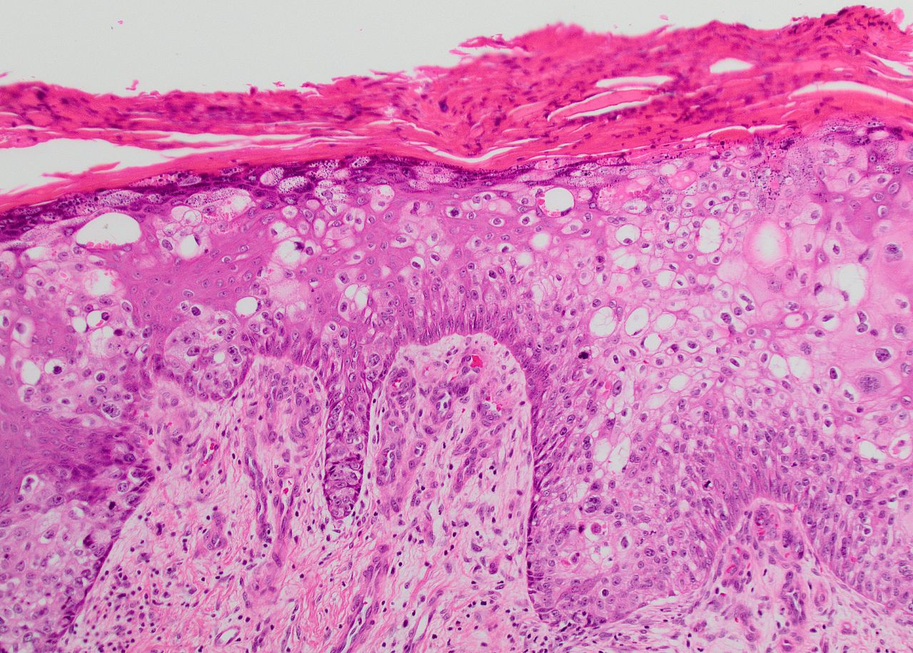 File:Skin SCCIS PagetoidandConventional 15BR30103.jpg