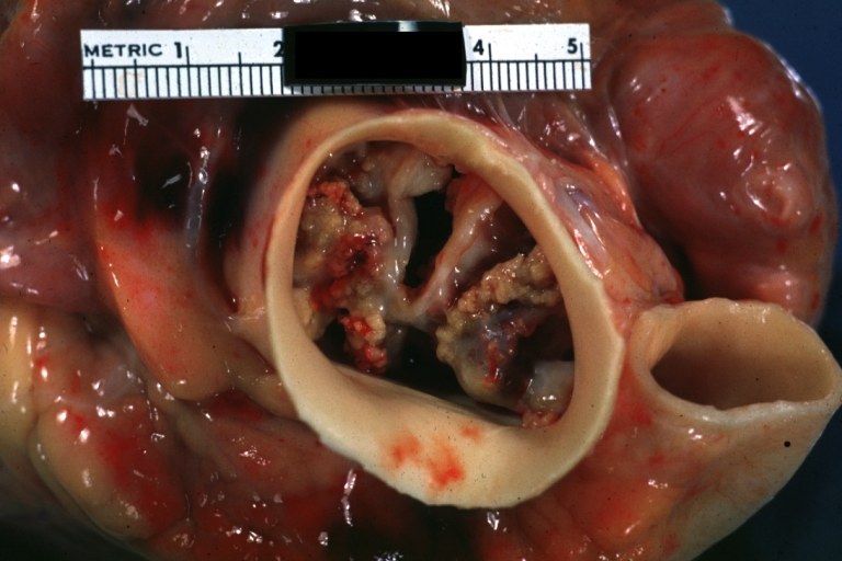 Unicuspid aortic stenosis