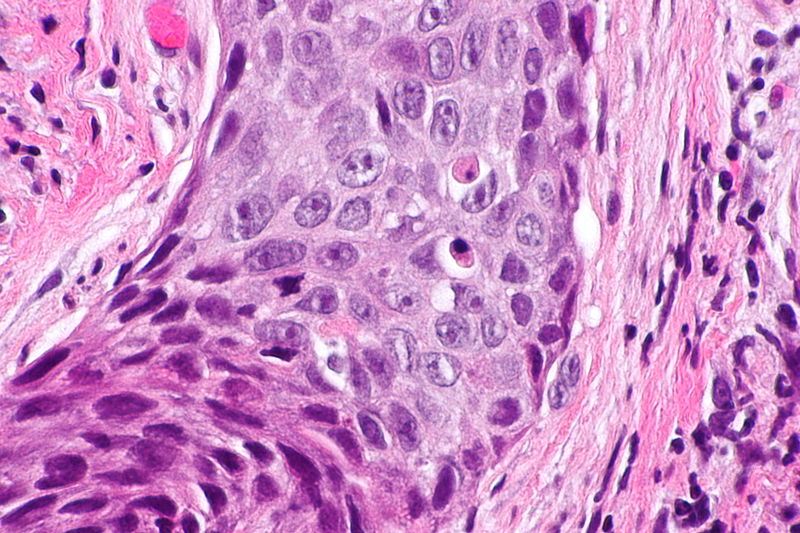 Laryngeal squamous carcinoma (Very High Magnification)[7]