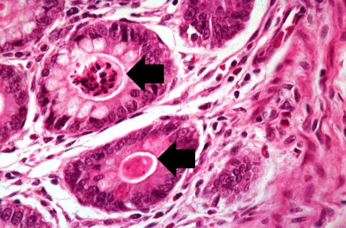 This higher-power photomicrograph shows more clearly the eosinophilic debris (arrows) in the intestinal crypts.