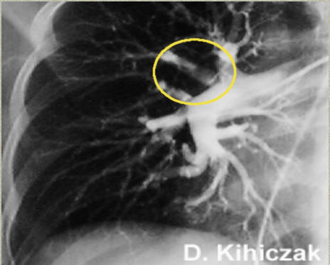 Pulmonary angiogram in a patient with pulmonary embolus. A thrombus is observed in the area within the yellow circle. Source