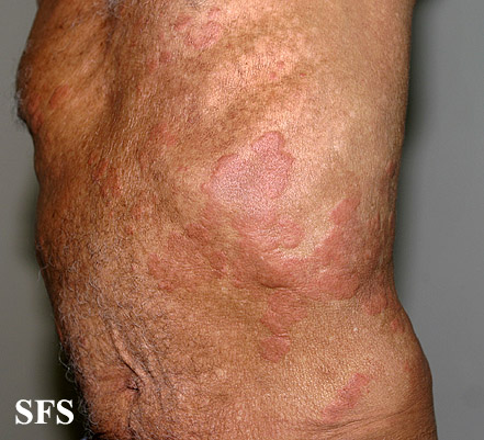 Well's syndrome. Adapted from Dermatology Atlas.[4]