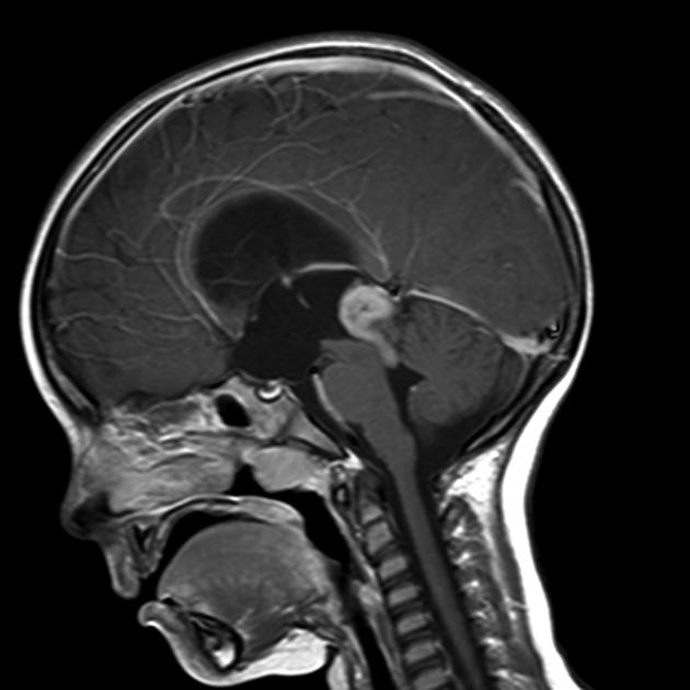 Sagittal T1 with contrast CT image of pineoblastoma demonstrating an enhancing mass in the region of the pineal gland is present. A tongue of tissue is observed extending inferiorly through the aqueduct, obstructing it, and resulting in hydrocephalus with transependymal edema.[18]