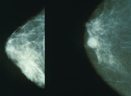 Mammography pictures, normal (left) and cancerous (right)