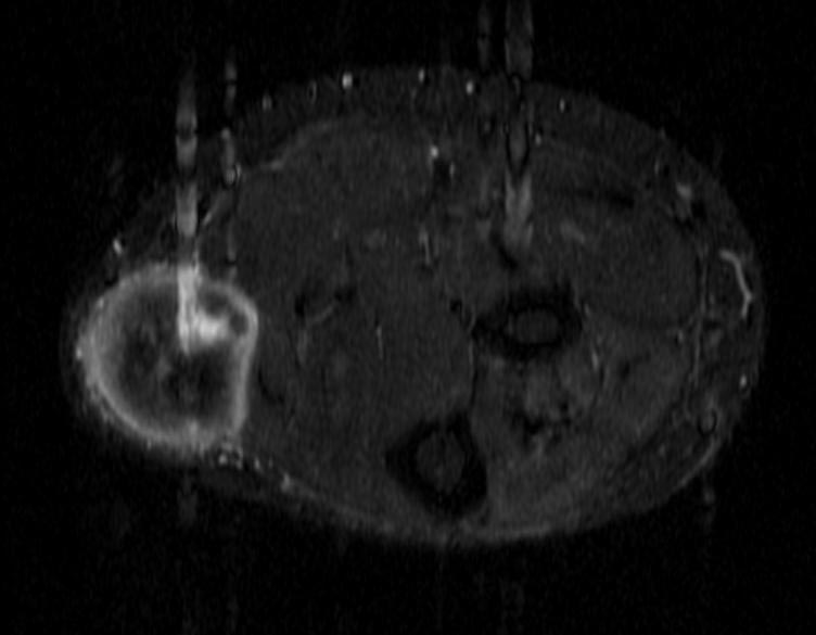 File:Split fat sign MRI 003.jpg