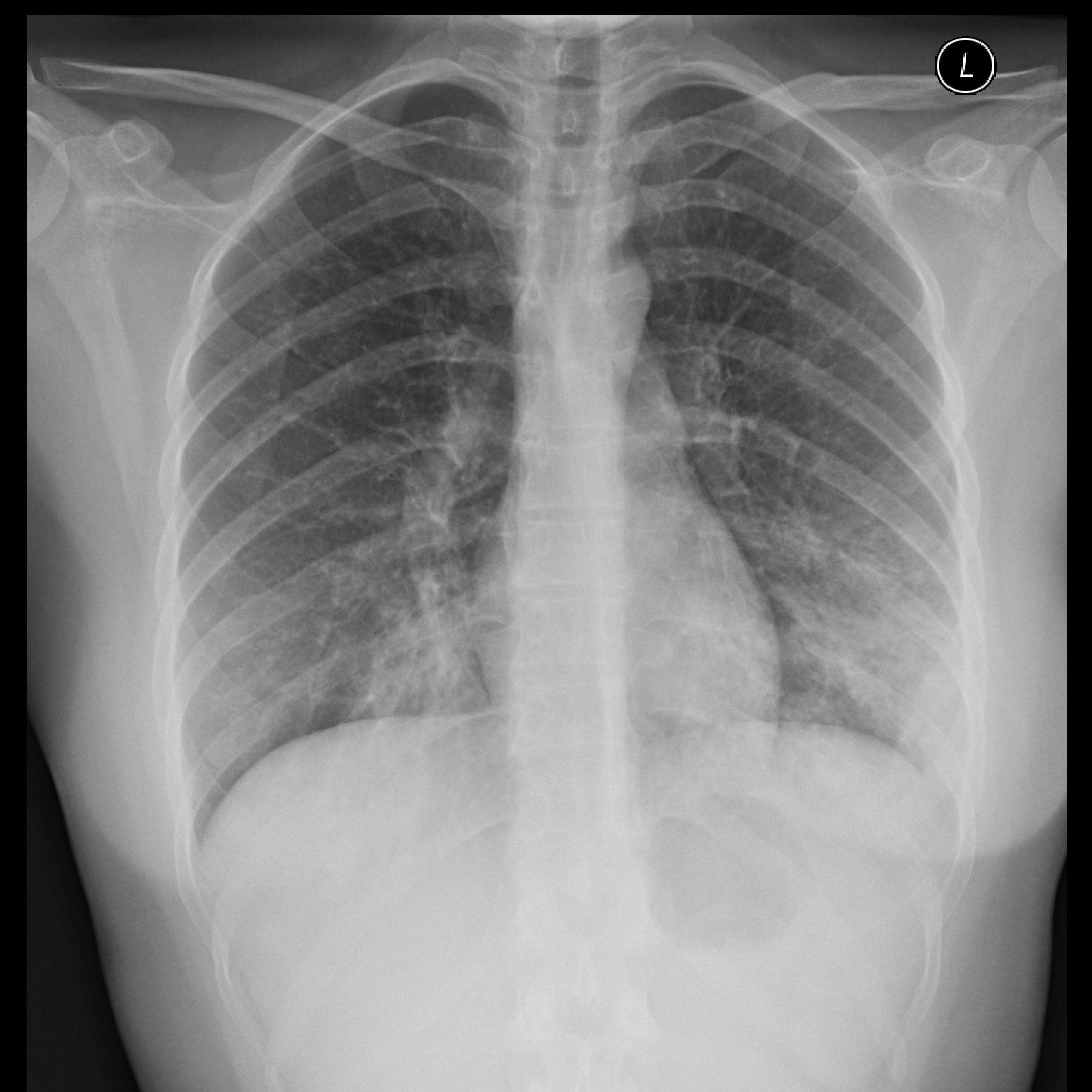 File:Atypical-pneumonia-mycoplasma.jpg