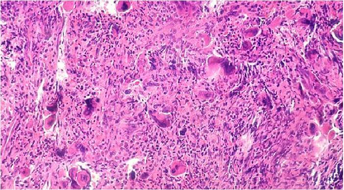 Bone marrow in idiopathic myelofibrosis