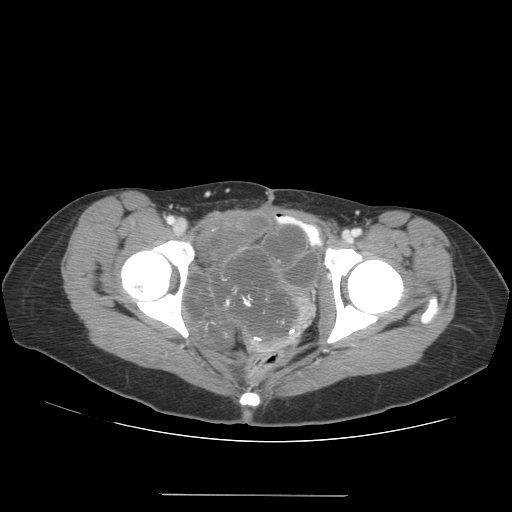 CT images demonstrate a large pelvic chondrosarcoma