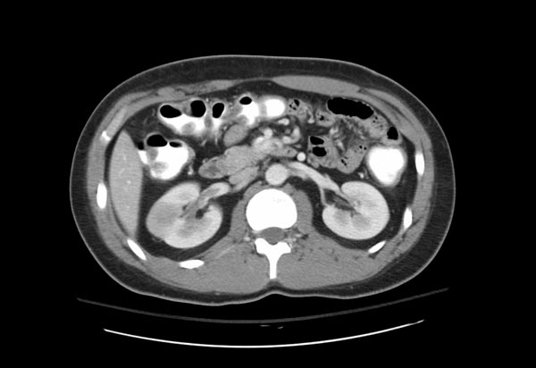 CT demonstrate a right renal infarction patient#2 Image courtesy of RadsWiki and copylefted