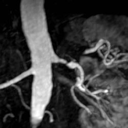 File:Renal artery stenosis 013.jpg