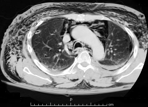 A CT scan showing air in the mediastinum