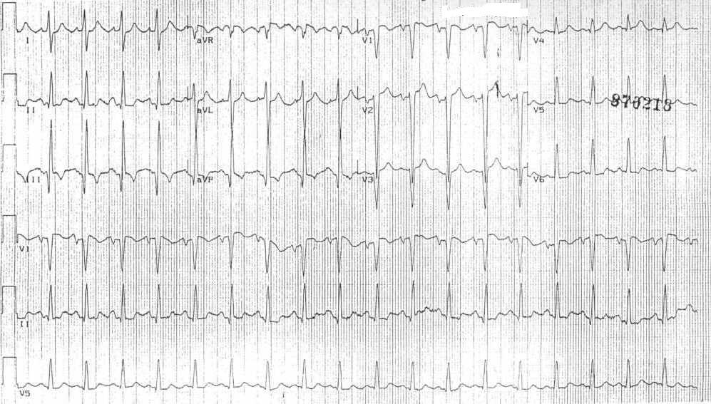 12 lead EKG at admission
