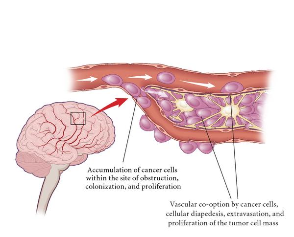 Overexpression of the adhesion molecules makes it easy for tumor cells to target and adhere to endothelial lining in the parenchyma, making it possible for these endothelial-adhesive interactions to enhance the possibility of brain metastasis. Direct neurotropic interactions with brain homing mechanisms result in brain metastases. “Vascular co-option” is the ability of metastatic cells to grow along the preexisting vessels, and once adherent to the vascular basement membrane, tumor cells can extravasate into the parenchyma, the vascular basement membrane thus being the “soil” for brain metastases.[1]