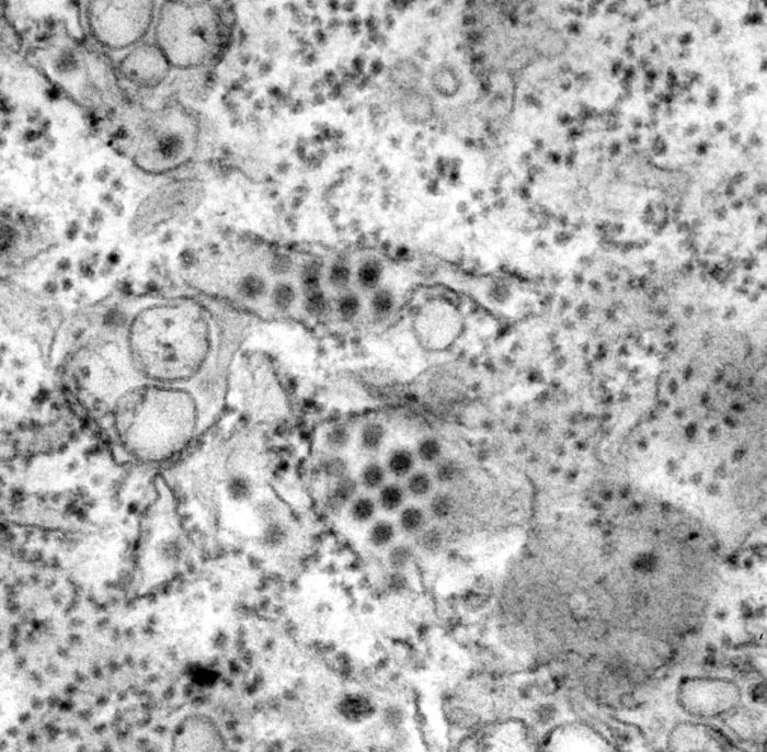 (TEM) depicts a number of round, Dengue virus particles that were revealed in this tissue specimen. From Public Health Image Library (PHIL). [2]