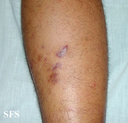 Kaposi's sarcoma. Adapted from Dermatology Atlas.[3]
