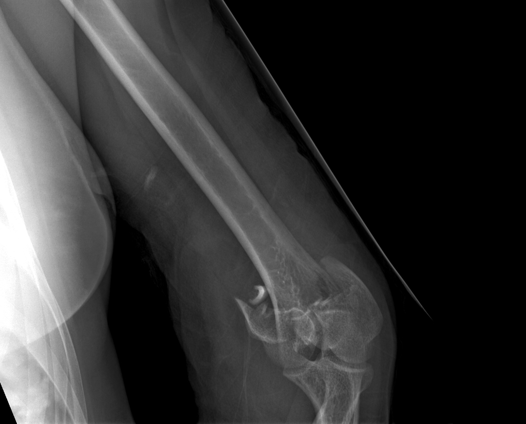 Condylar and supracondylar fracture of the elbow.