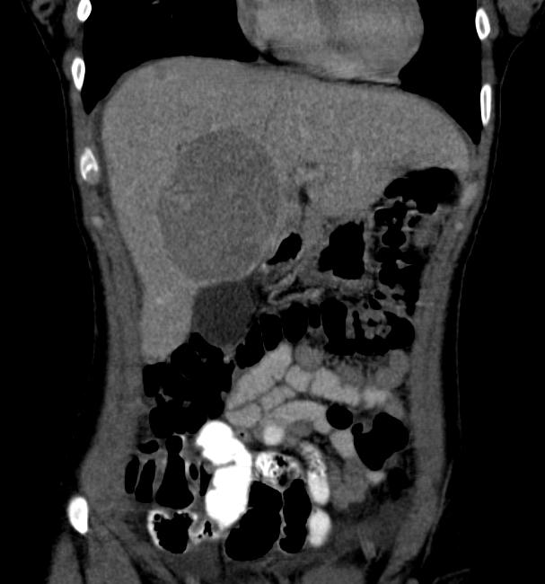 CT portal venous phase: A patient with multiple adenoma