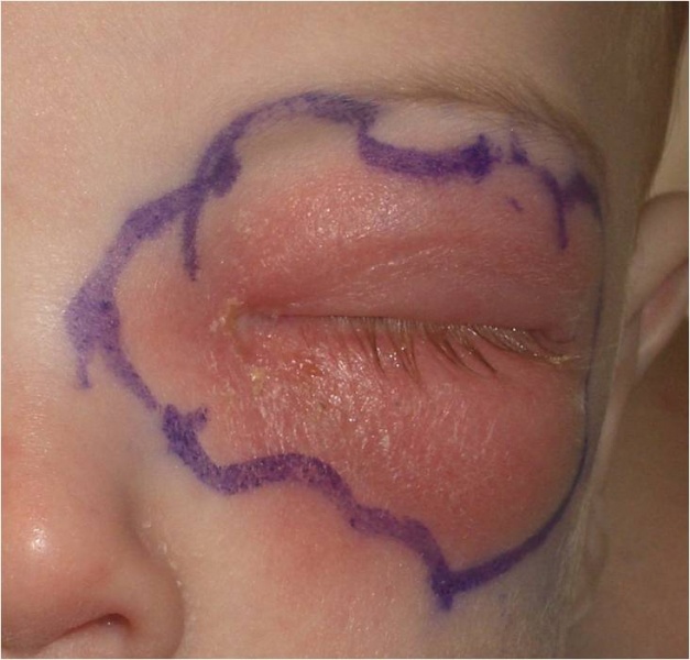 Orbital cellulitis in the left eye of a child