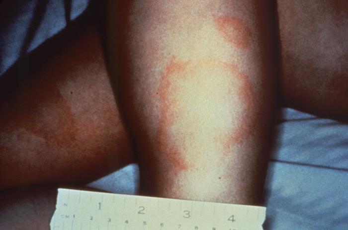 Medial aspect of the right calf of a patient who’d presented with what was diagnosed as Lyme disease. From Public Health Image Library (PHIL). [2]