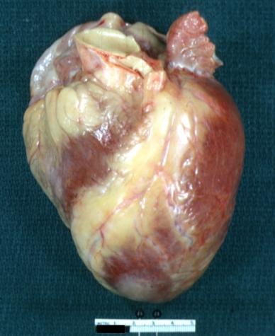 Left Ventricular Hypertrophy: Gross natural color anterior view intact heart showing disproportionate size of left ventricle by its inferior extent much below the right ventricle apex (quite good example)