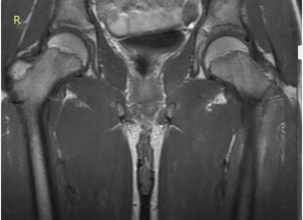 MRI findings in Osteomyelitis
