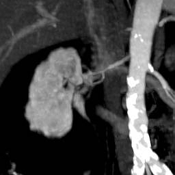 File:Renal artery stenosis 031.jpg