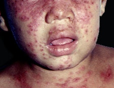 Atopic Dermatitis. Adapted from Dermatology Atlas.