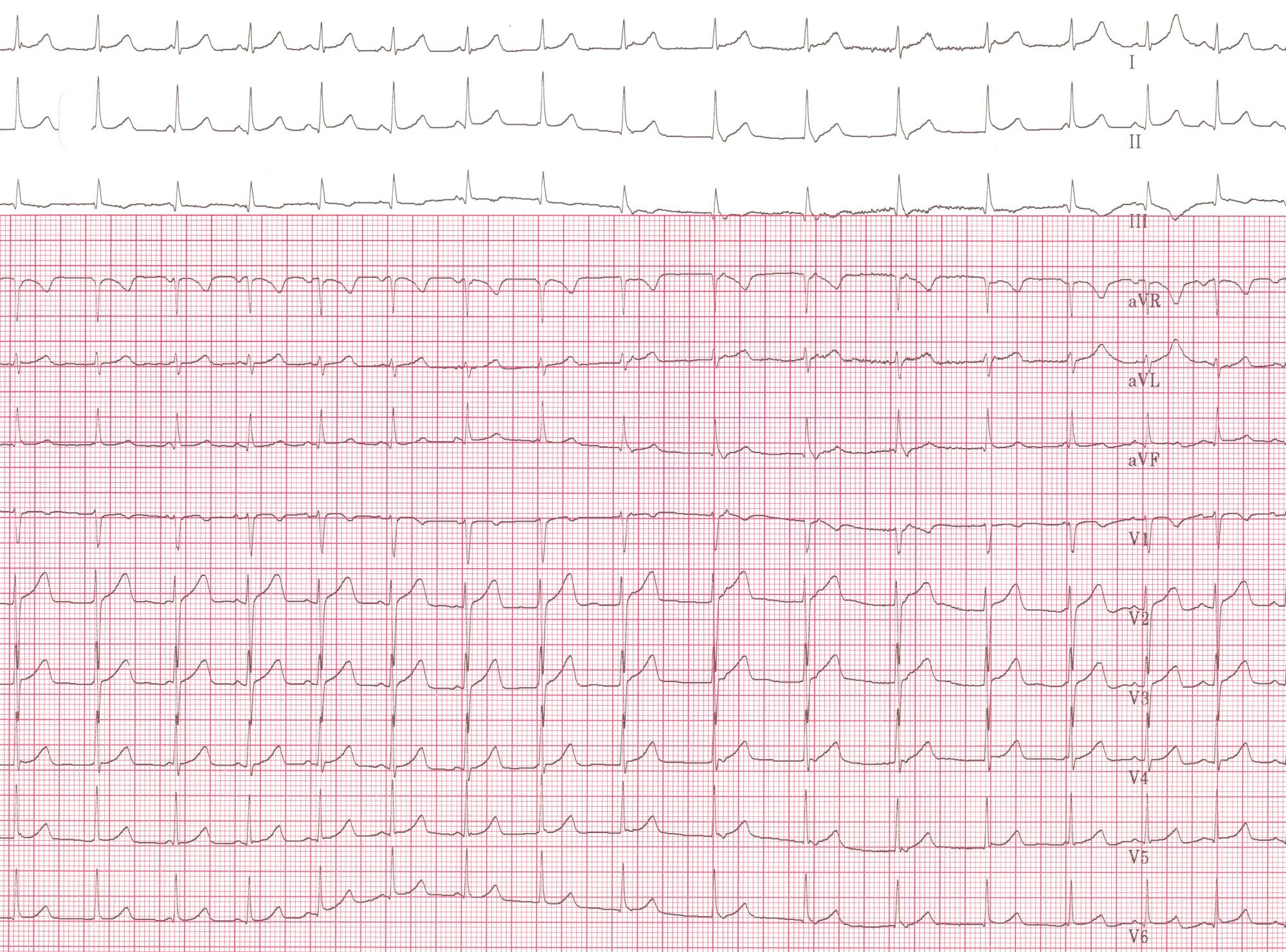 12 lead EKG: Junctional Ectopic Tachycardia (JET)