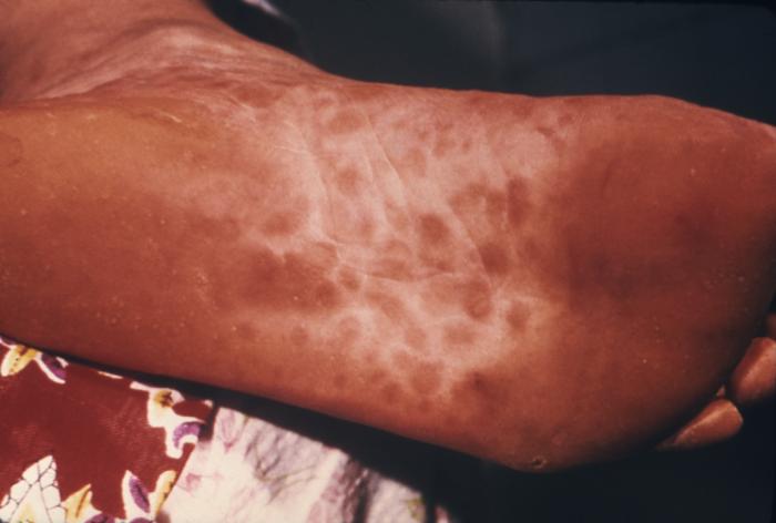 This patient presented with a papular rash on the sole of the foot due to secondary syphilis. The second stage of syphilis starts when one or more areas of the skin break into a rash that appears as rough, red or reddish brown spots both on the palms of hands and on the bottoms of feet. Even without treatment, rashes clear up by itself. Adapted from CDC