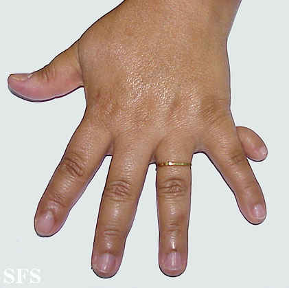 Rudimentary polydactyly. Adapted from Dermatology Atlas.[2]