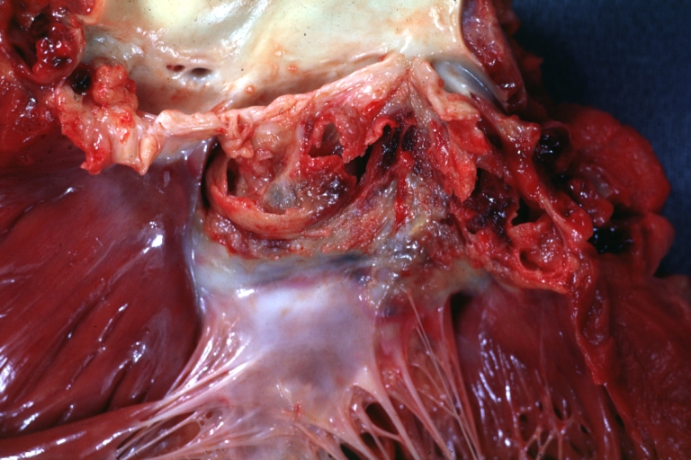 Sinus of Valsalva Aneurysm Infected: Gross; natural color, close-up view of coronary cusps with extensive ulceration and fibrinous material. Staphylococcus infection of a bicuspid valve.