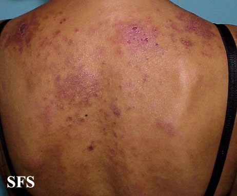 Subacute cutaneous lupus erythematosus. Adapted from Dermatology Atlas.[6]