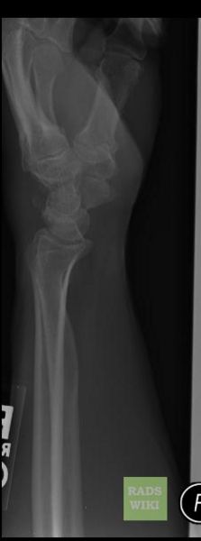 Triquetral fracture Image courtesy of RadsWiki and copylefted