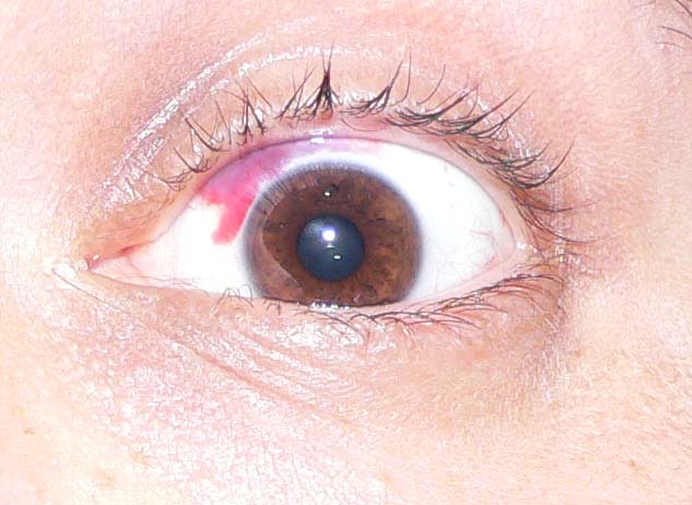Eye hemorrhage.jpg