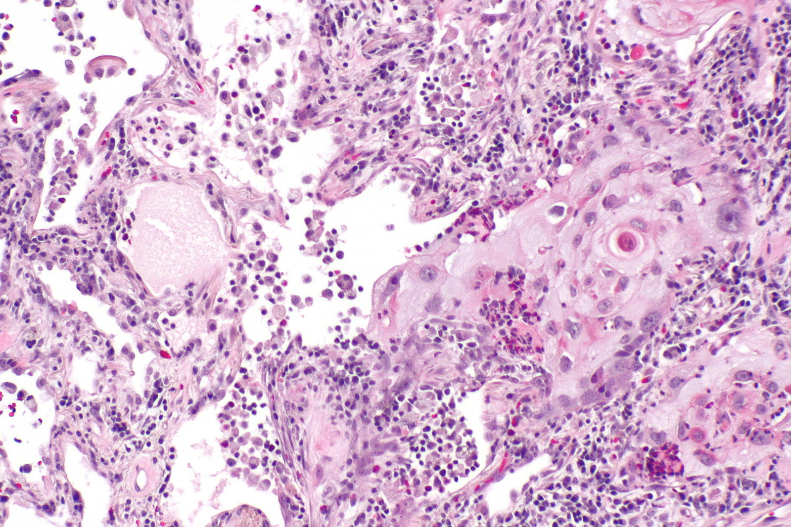 Micropathology: Squamous cell carcinoma of the lung. H&E stain via, Wikimedia Commons By Nephron (Own work)[7]