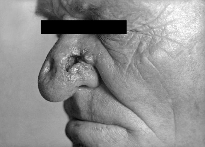 A photograph of a young child with congenital syphilis exhibiting intraoral mucous patches and facial skin lesions. An infant demonstrating mucous patches and skin lesions resulting from congenital syphilis. In 1998, 81.3% of reported cases of CS occurred because the mother received no penicillin treatment or inadequate treatment before or during pregnancy. Adapted from CDC