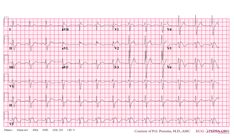 File:Brugada syndrome type1 example1.png