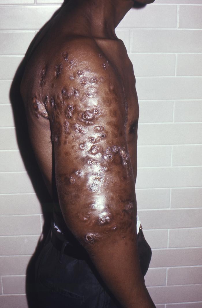 Posterior perspective of patient with nocardiosis infection of his right upper arm due to Gram-positive Nocardia brasiliensis bacteria. From Public Health Image Library (PHIL). [3]
