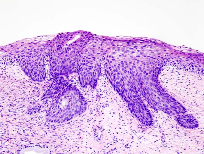 Histopathologic image (H&E stain) of cervical intraepithelial neoplasia.