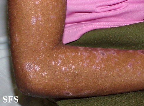 Lichen planus actinicus. Adapted from Dermatology Atlas.[1]