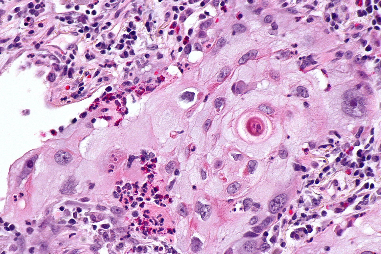 Micropathology: Squamous cell carcinoma of the lung. H&E stain via, Wikimedia Commons By Nephron (Own work) [8]