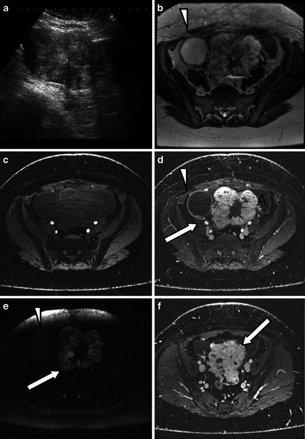 File:Struma ovarii - ultrasound 2.jpg