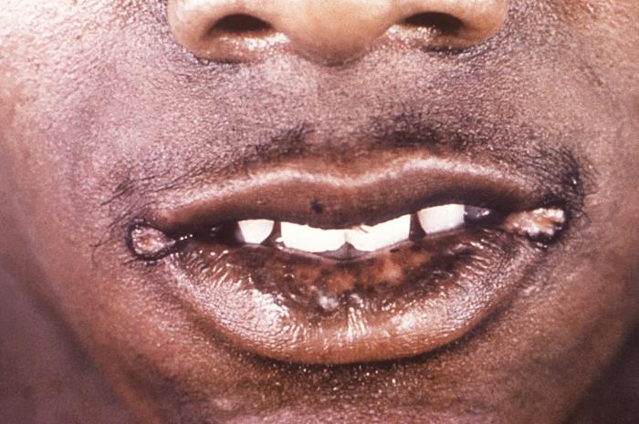 This image depicts the face of a patient, who’d presented with split syphilitic papules, located at the bilateral labial commissures, due to what was diagnosed as secondary syphilis. The secondary stage of syphilis is characterized by the manifestation of a skin rash and mucous membrane lesions. This stage typically starts with the development of a rash on one or more areas of the body. The rash usually does not cause itching. Rashes associated with secondary syphilis can appear as the chancre is healing or several weeks after the chancre has healed. The characteristic rash of secondary syphilis may appear as rough, red, or reddish brown spots both on the palms of the hands and the bottoms of the feet. However, rashes with a different appearance may occur on other parts of the body, sometimes resembling rashes caused by other diseases. Sometimes rashes associated with secondary syphilis are so faint that they are not noticed. In addition to rashes, symptoms of secondary syphilis may include fever, swollen lymph glands, sore throat, patchy hair loss, headaches, weight loss, muscle aches, and fatigue. The signs and symptoms of secondary syphilis will resolve with or without treatment, but without treatment, the infection will progress to the latent and possibly late stages of disease. Adapted from CDC