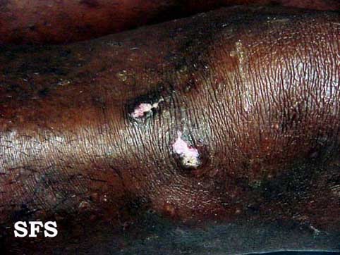Lupus erythematosus chronicus disseminatus superficialis. Adapted from Dermatology Atlas.[4]